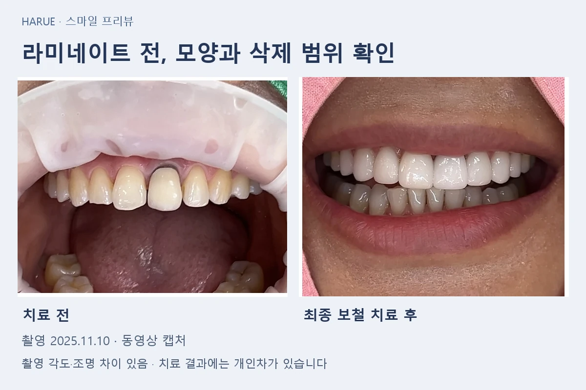 스마일 프리뷰 안내와 앞니 심미치료 전후 비교 — 2025년 11월 10일 촬영 영상 캡처