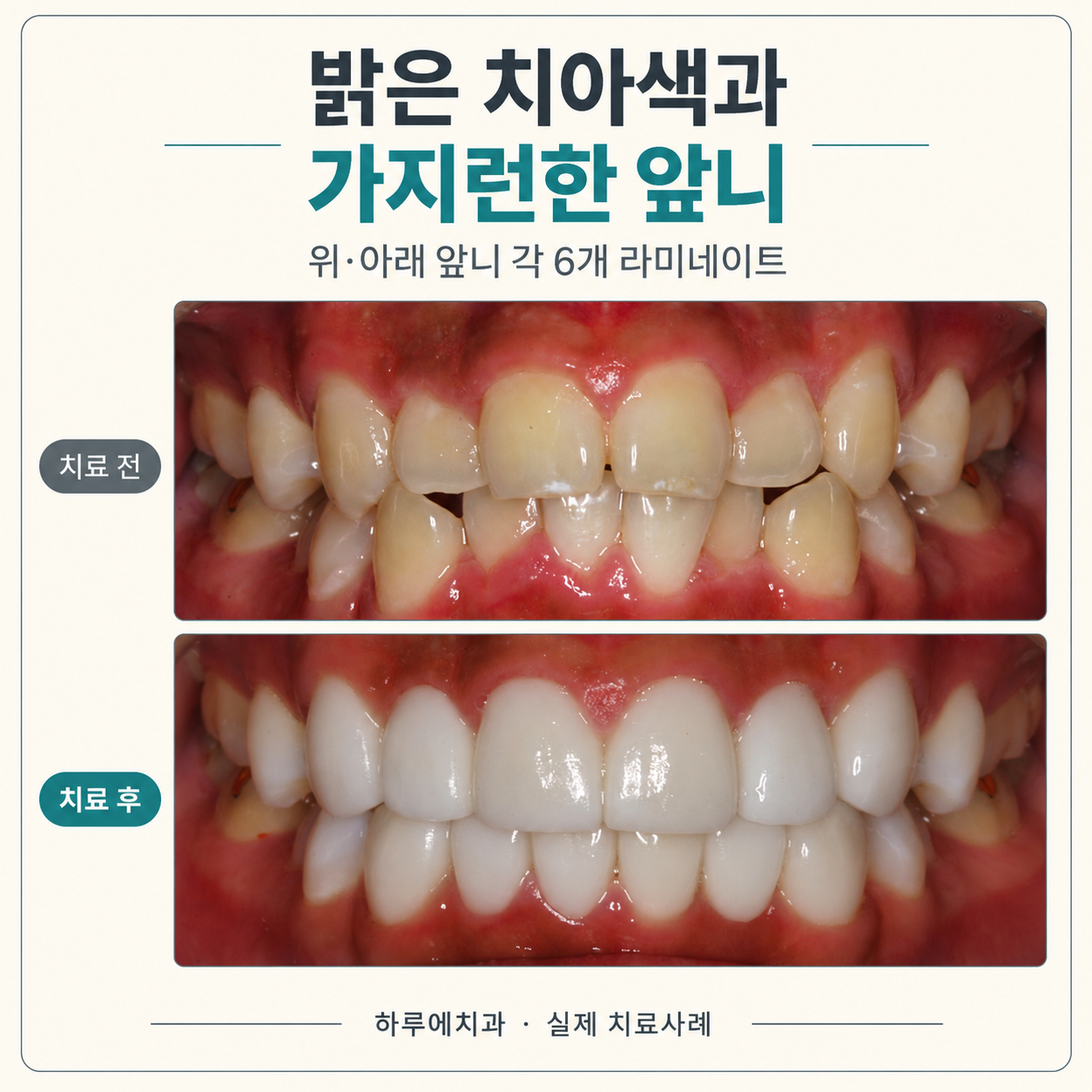 밝은 치아색과 앞니 형태를 조정한 위아래 각 6개 라미네이트 실제 치료 전후