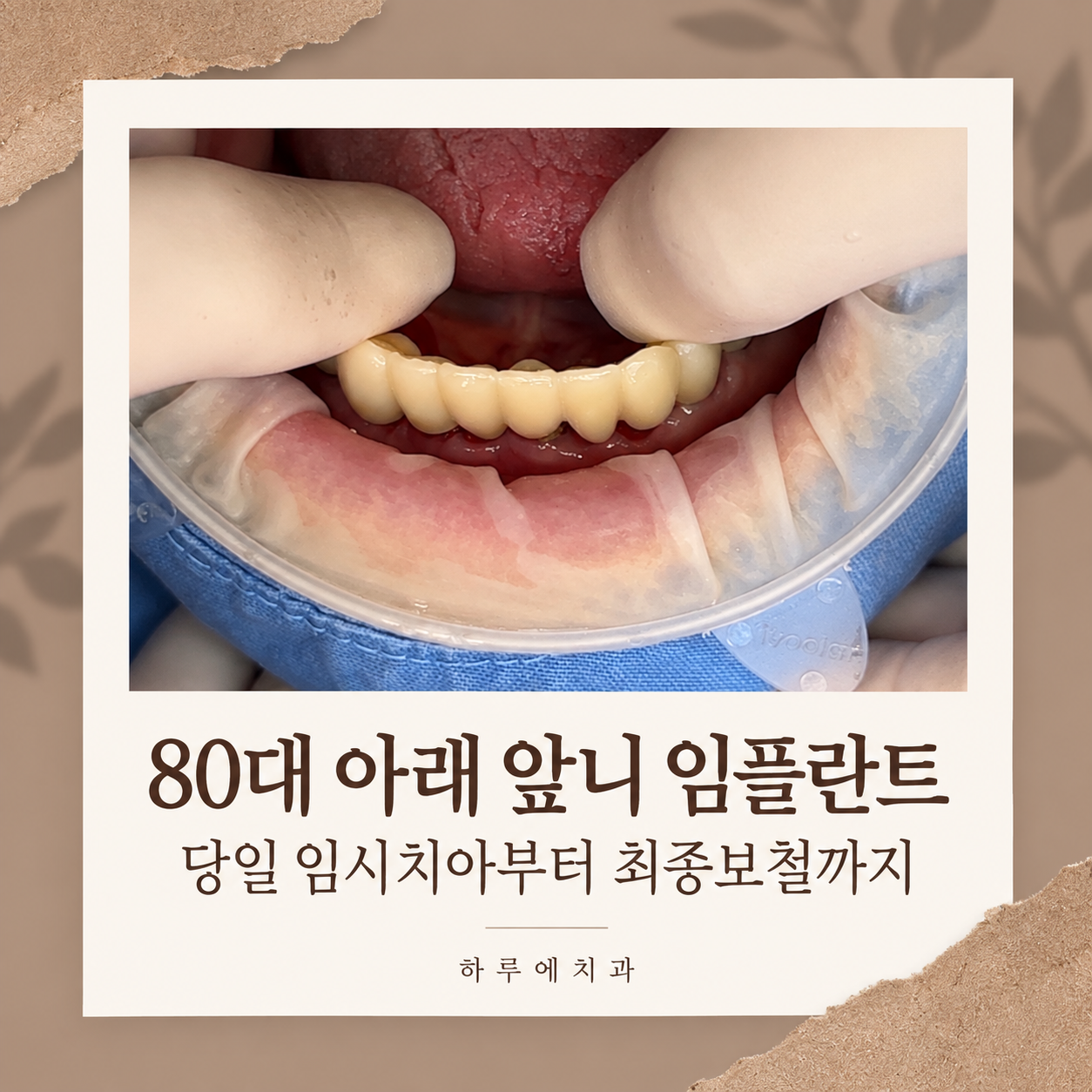 80대 아래 앞니 임플란트 사례 대표이미지, 당일 임시치아부터 최종보철까지