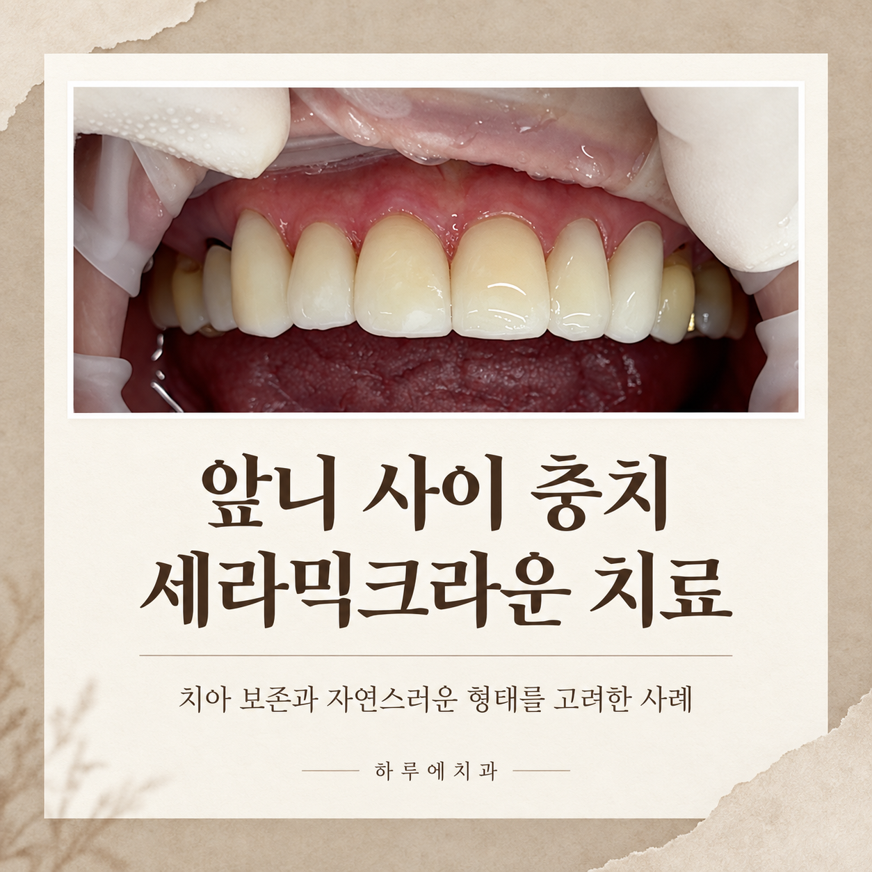 앞니 사이 충치를 세라믹크라운으로 치료한 사례 대표이미지
