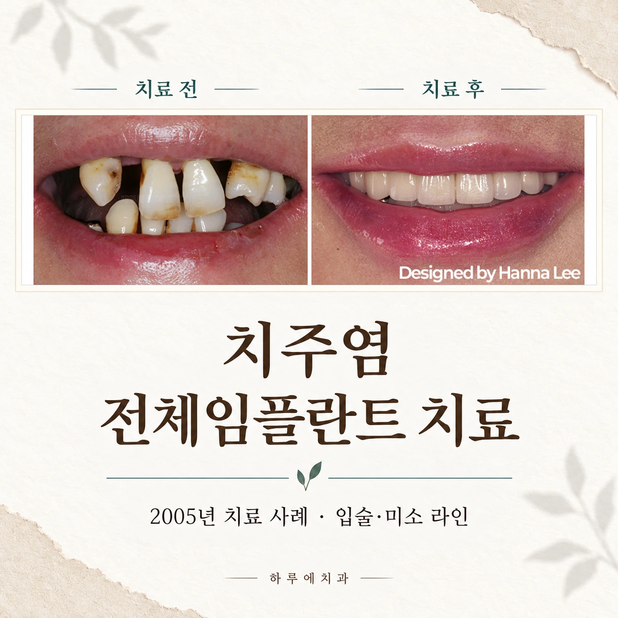 2005년 치주염 전체임플란트 치료 전후 정면 사진과 입술·미소 라인 사례 안내 썸네일