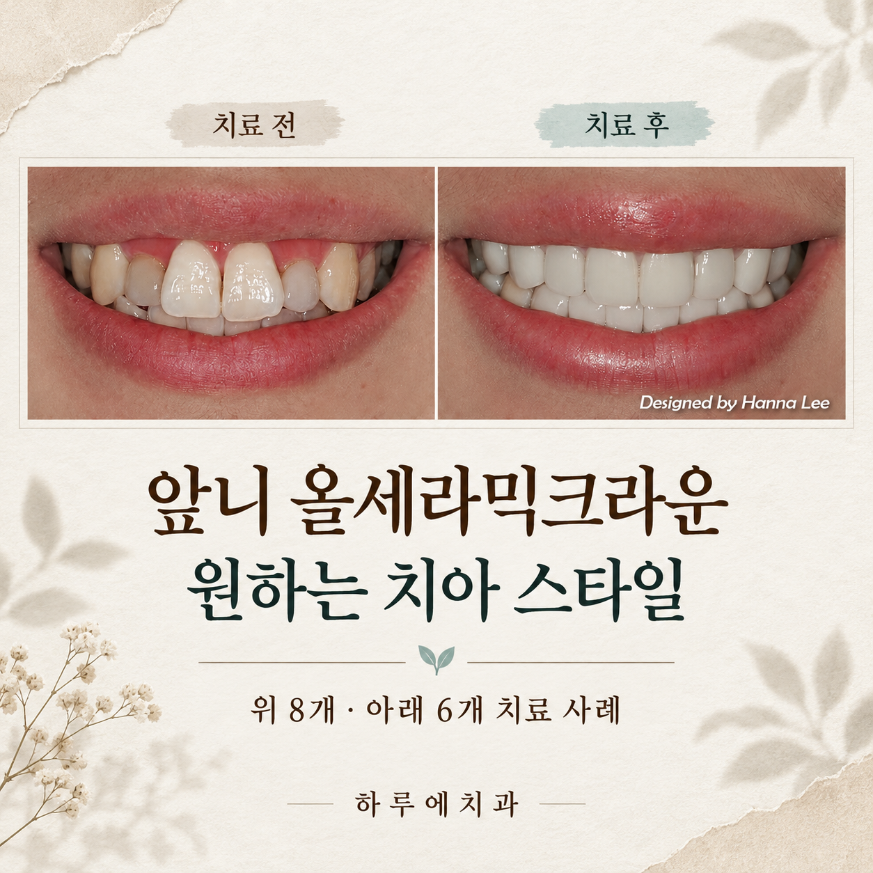 앞니 올세라믹크라운 위 8개 아래 6개 치료 전후와 환자가 원한 치아 스타일을 소개하는 대표이미지