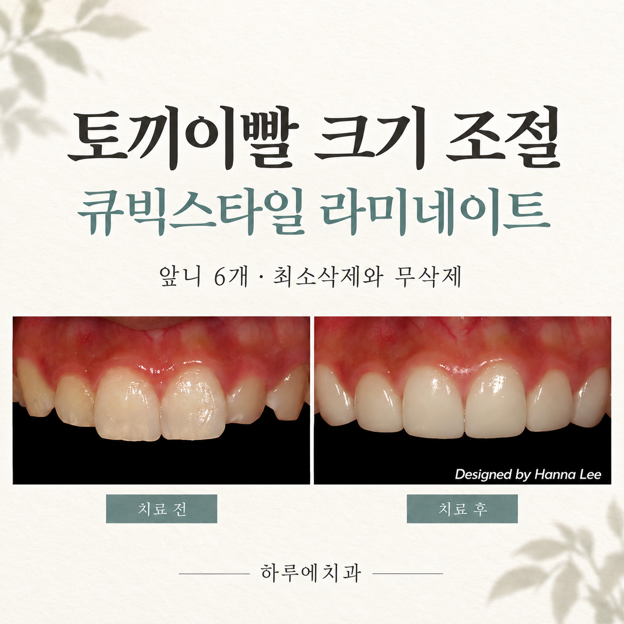 토끼이빨 크기를 조절한 앞니 6개 큐빅스타일 라미네이트 치료 전후 대표이미지