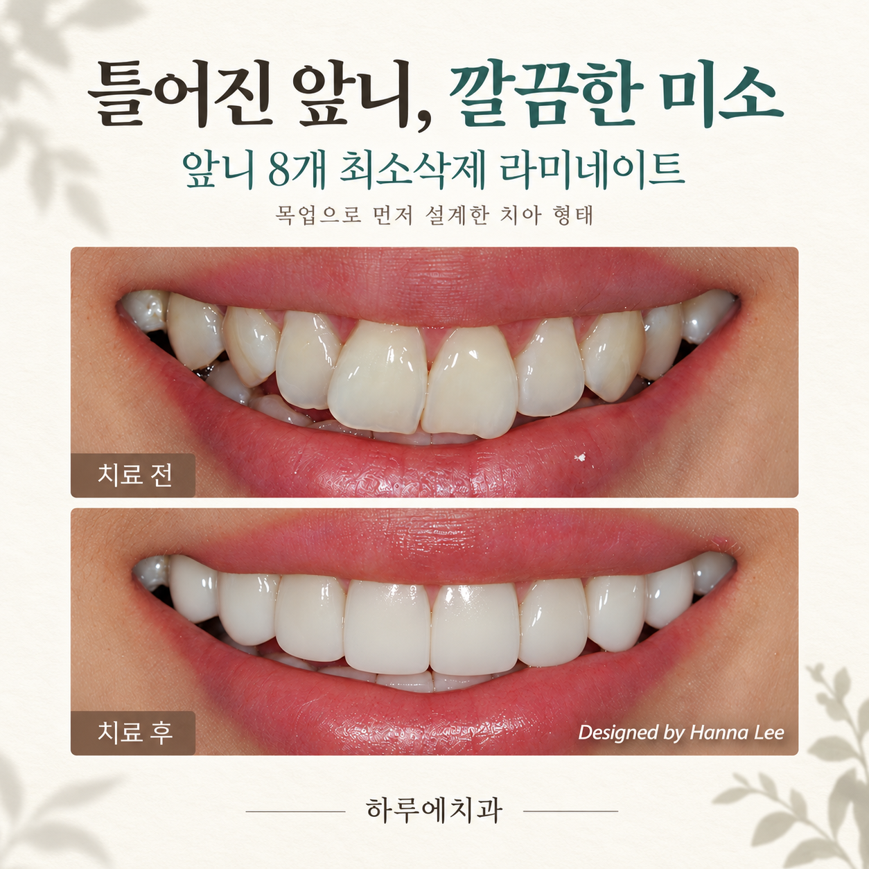 틀어진 위 앞니 8개를 최소삭제 라미네이트로 치료한 실제 전후 사례 대표이미지