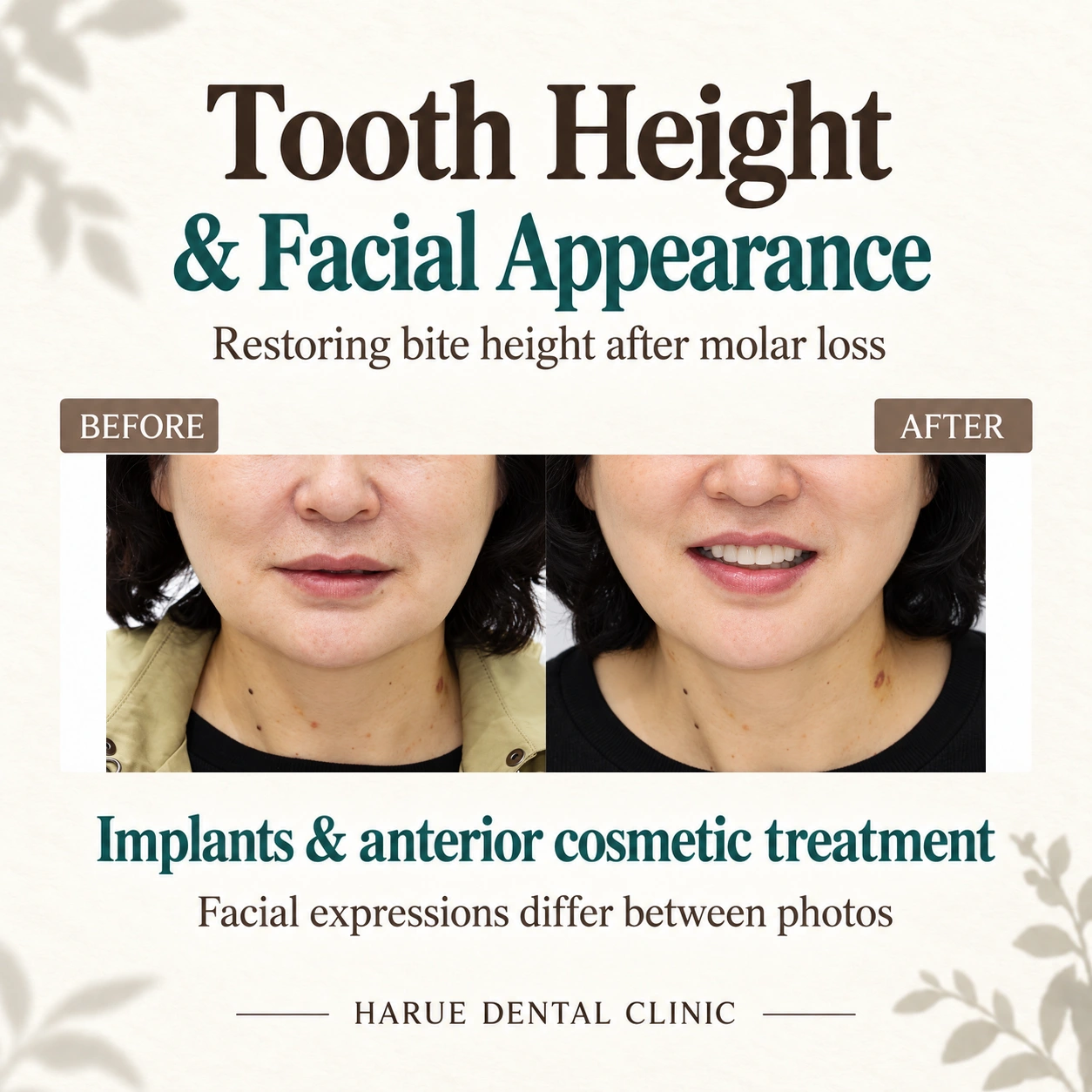 Actual lower-face before-and-after photographs for an occlusal vertical-dimension restoration case combining implants and anterior cosmetic treatment