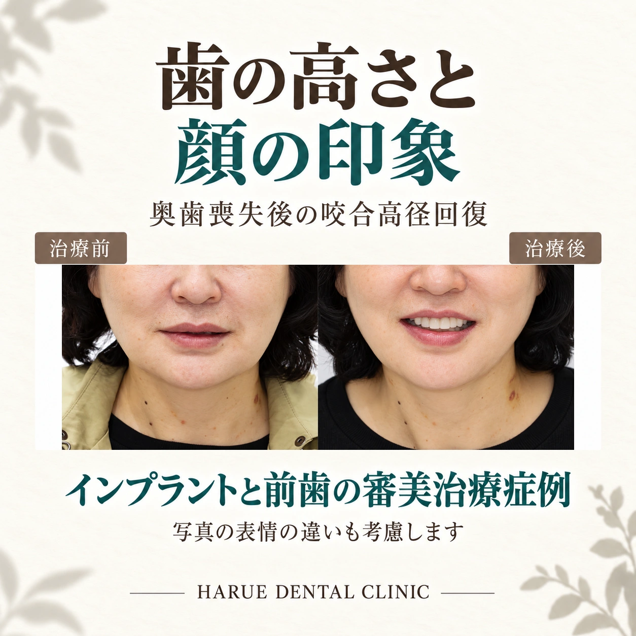 奥歯喪失後の咬合高径回復とインプラント・前歯審美治療症例の実際の顔下部の治療前後写真を用いたサムネイル