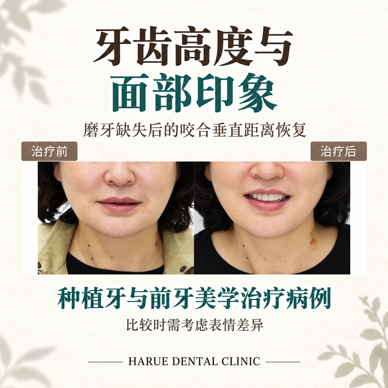 磨牙缺失后恢复咬合垂直距离并联合种植牙与前牙美学治疗的实际下部面容前后照片缩略图