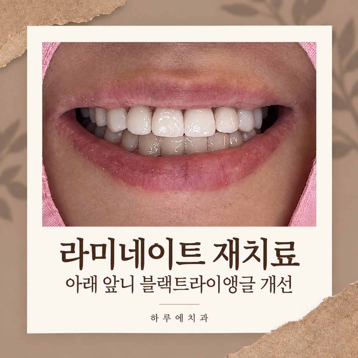 라미네이트 재치료와 아래 앞니 블랙트라이앵글 개선 사례 대표이미지