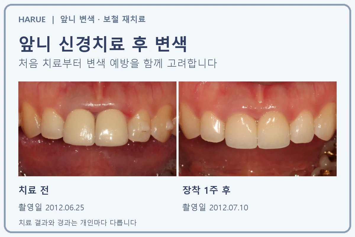 앞니 신경치료 후 변색 예방과 보철 재치료 사례: 치료 전 2012년 6월 25일, 장착 1주 후 2012년 7월 10일